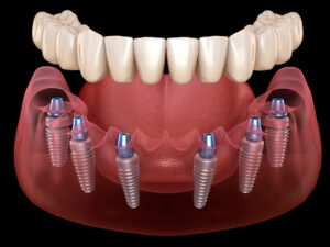 implante dentário